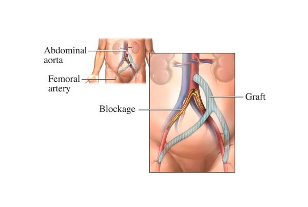 Aorto Iliac Bypass Surgery