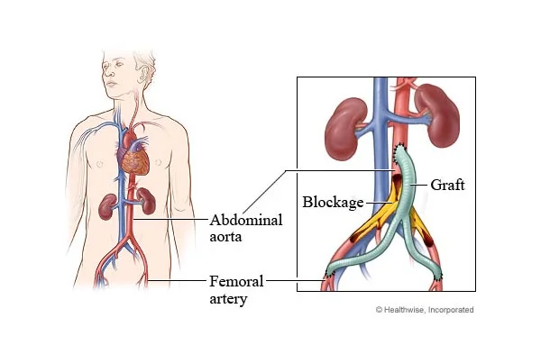 Aortofemoral Bypass Surgery