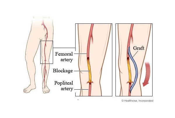 Femoral Popliteal Bypass Surgery