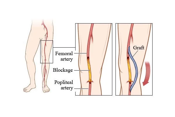 Femoral Distal Bypass Surgery