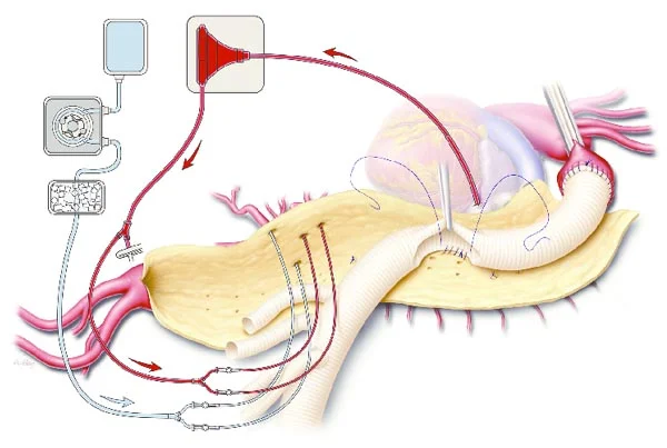 Visceral Bypass Surgery