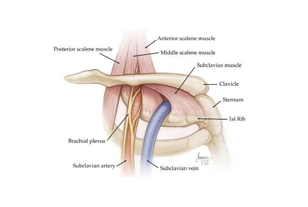 Surgery For Thoracic Outlet Syndrome