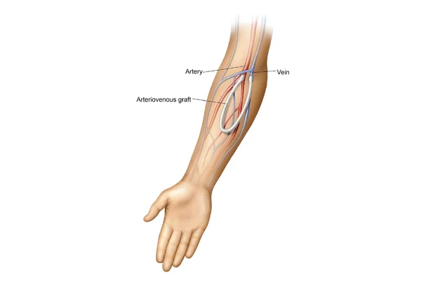 Arterial Bypass Surgery