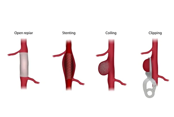 Aneurysm Surgery