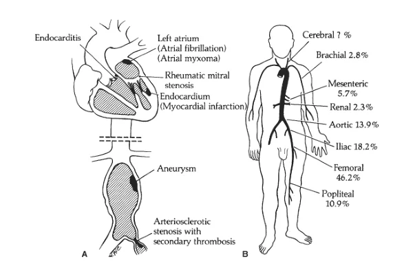 Embolectomy / Thrombectomy