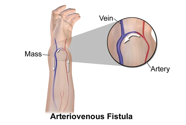 Arteriovenous Fistula