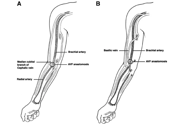Brachiocephalic Fistula