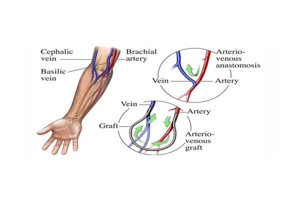 Arterio Venous Grafting