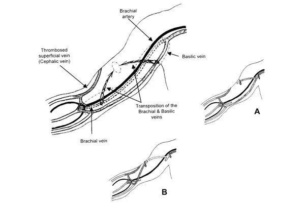 Basilic Vein Transposition