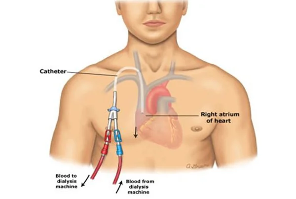 Permacath Insertion