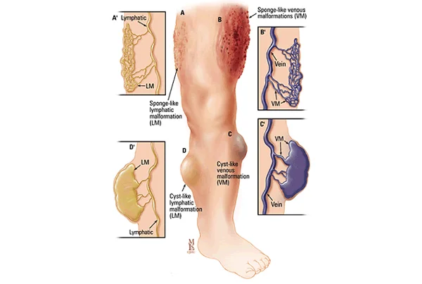 Vascular Malformation
