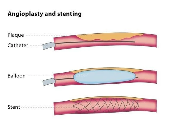 Angioplasty Stenting