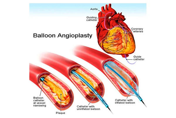 Angioplasty with Drug Coated Balloons