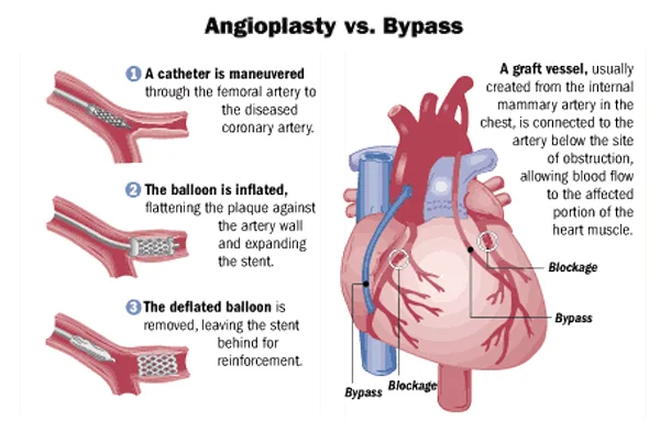Minimally Invasive Endovascular Procedure