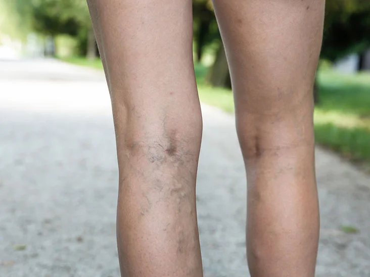 Varicose Vein